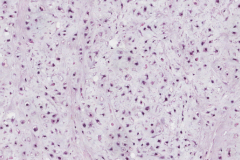 Chondrosarcoma of the larynx