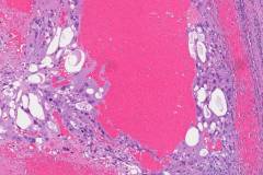 Metastatic choriocarcinoma from the testis to the retroperitoneum