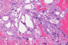 Metastatic choriocarcinoma from the testis to the retroperitoneum