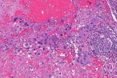 Metastatic choriocarcinoma from the testis to the retroperitoneum