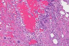 Metastatic choriocarcinoma from the testis to the retroperitoneum