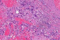 Metastatic choriocarcinoma from the testis to the retroperitoneum