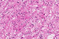 Chromophobe renal cell carcinoma