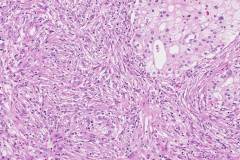 Chromophobe renal cell carcinoma with sarcomatoid differentiation