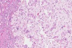 Chromophobe renal cell carcinoma