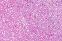 Chromophobe renal cell carcinoma with sarcomatoid differentiation