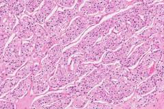 Chromophobe renal cell carcinoma