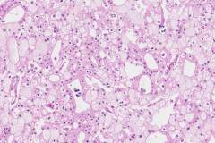 Chromophobe renal cell carcinoma