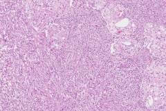 Chromophobe renal cell carcinoma with sarcomatoid differentiation