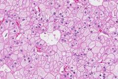 Chromophobe renal cell carcinoma