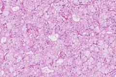 Chromophobe renal cell carcinoma