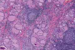 Chronic lymphocytic thyroiditis