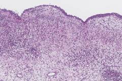 Chronic eosinophilic rhinosinusitis