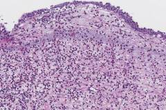 Chronic eosinophilic rhinosinusitis