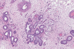 Chronic rhinosinusitis