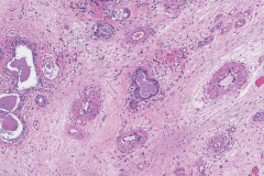 Chronic rhinosinusitis