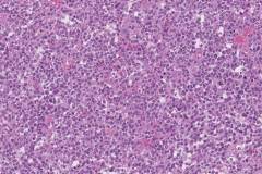 CIC translocation associated sarcoma