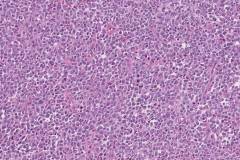 CIC translocation associated sarcoma