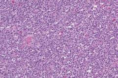 CIC translocation associated sarcoma