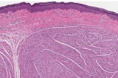 Circumscribed solitary neuroma