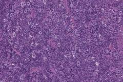 Nodular sclerosis classical Hodgkin lymphoma