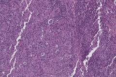 EBV positive classic Hodgkins lymphoma