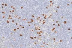 Hodgkins lymphoma, lymphocyte rich