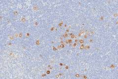 Hodgkins lymphoma, lymphocyte rich