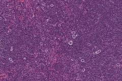 Hodgkins lymphoma, lymphocyte rich