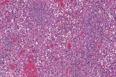 Hodgkins lymphoma, mixed type