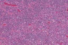 Hodgkins lymphoma, mixed type