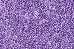 Classical Hodgkin lymphoma