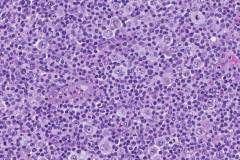 Classical Hodgkin lymphoma