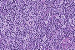 Classical Hodgkin lymphoma