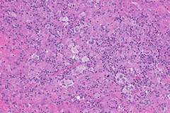 Nodular sclerosis classical Hodgkin lymphoma