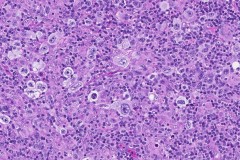 Classical Hodgkin lymphoma