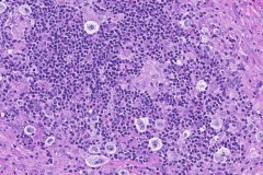 Classical Hodgkin lymphoma