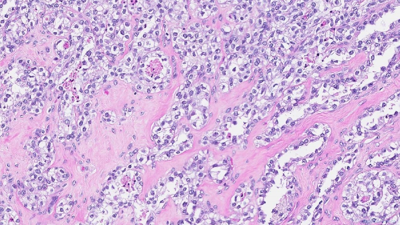 Clear Cell Carcinoma Of The Ovary Ottawa Atlas Of Pathology