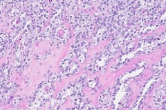 Clear cell carcinoma of the ovary