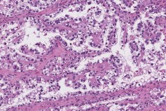 Clear cell carcinoma of the ovary