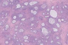 Clear cell carcinoma of the ovary