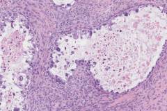 Clear cell carcinoma of the ovary