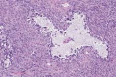 Clear cell carcinoma of the ovary