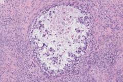 Clear cell carcinoma of the ovary