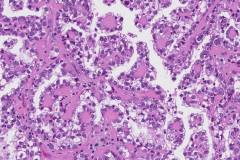 Clear cell carcinoma of the ovary