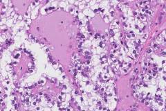 Clear cell carcinoma of the ovary