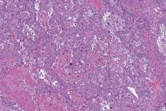 Clear cell carcinoma of the ovary