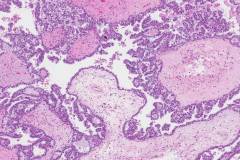 Clear cell carcinoma of the ovary