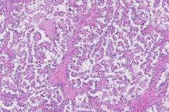 Clear cell carcinoma of the ovary