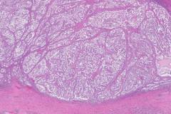 Clear cell carcinoma of the ovary